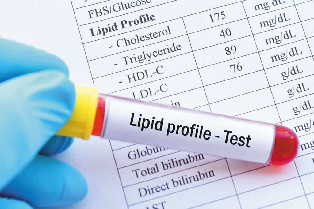lipid panel test in Dubai